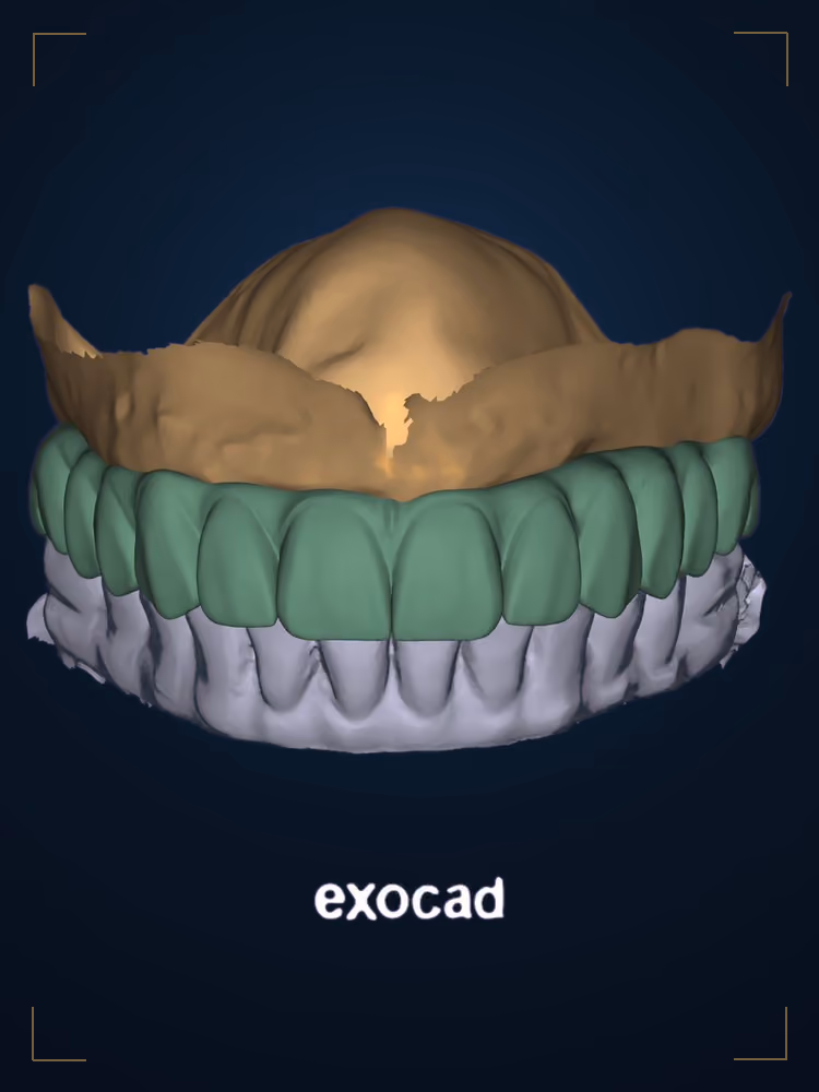 Capa da trilha de Exocad completo: enceramento digital sobre o modelo escaneado, com a gengiva em verde e a prótese em bege.