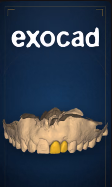 Capa da trilha de Exocad: arcada digitalizada com dois elementos protéticos desenhados.