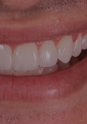 Capa da trilha de fotografia odontológica: fotografia clínica aproximada de um sorriso reabilitado.