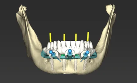 Tela de planejamento do coDiagnostiX, com os cortes tomográficos.