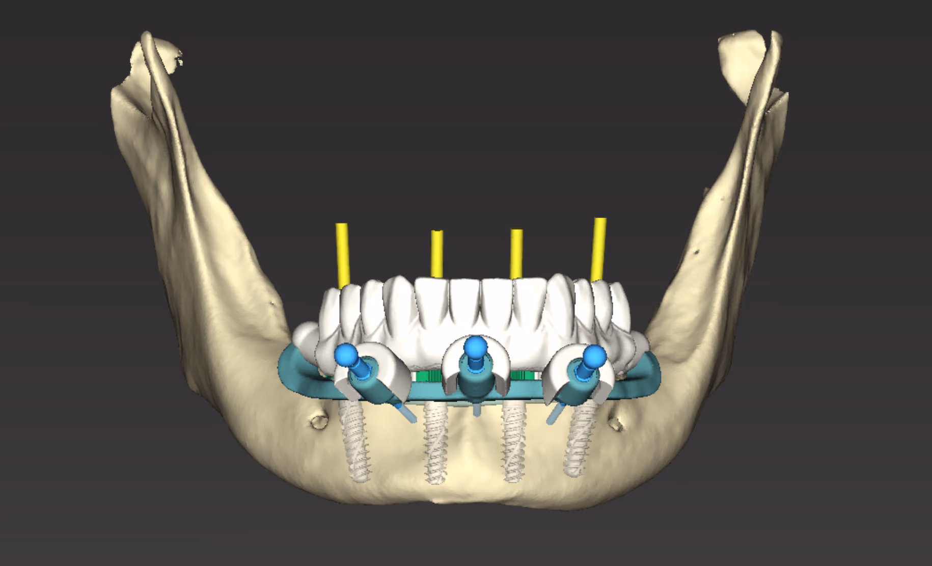 Planejamento de protocolo inferior sobre quatro implantes, com guia cirúrgico posicionado sobre a mandíbula em vista frontal