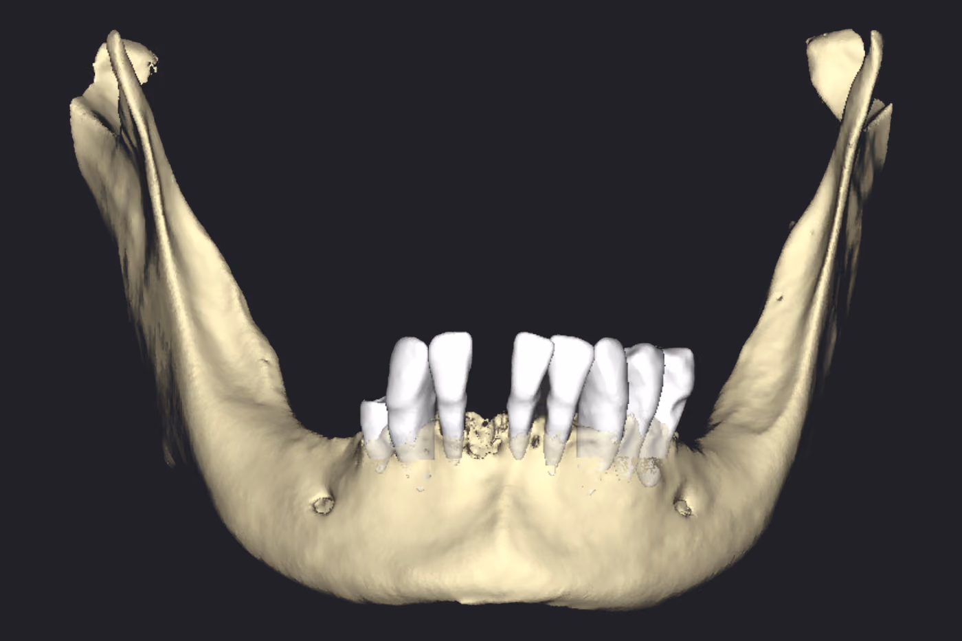 Mandíbula reconstruída em 3D com os dentes anteriores e pré-molares remanescentes, todos condenados, sobre osso com perda evidente.