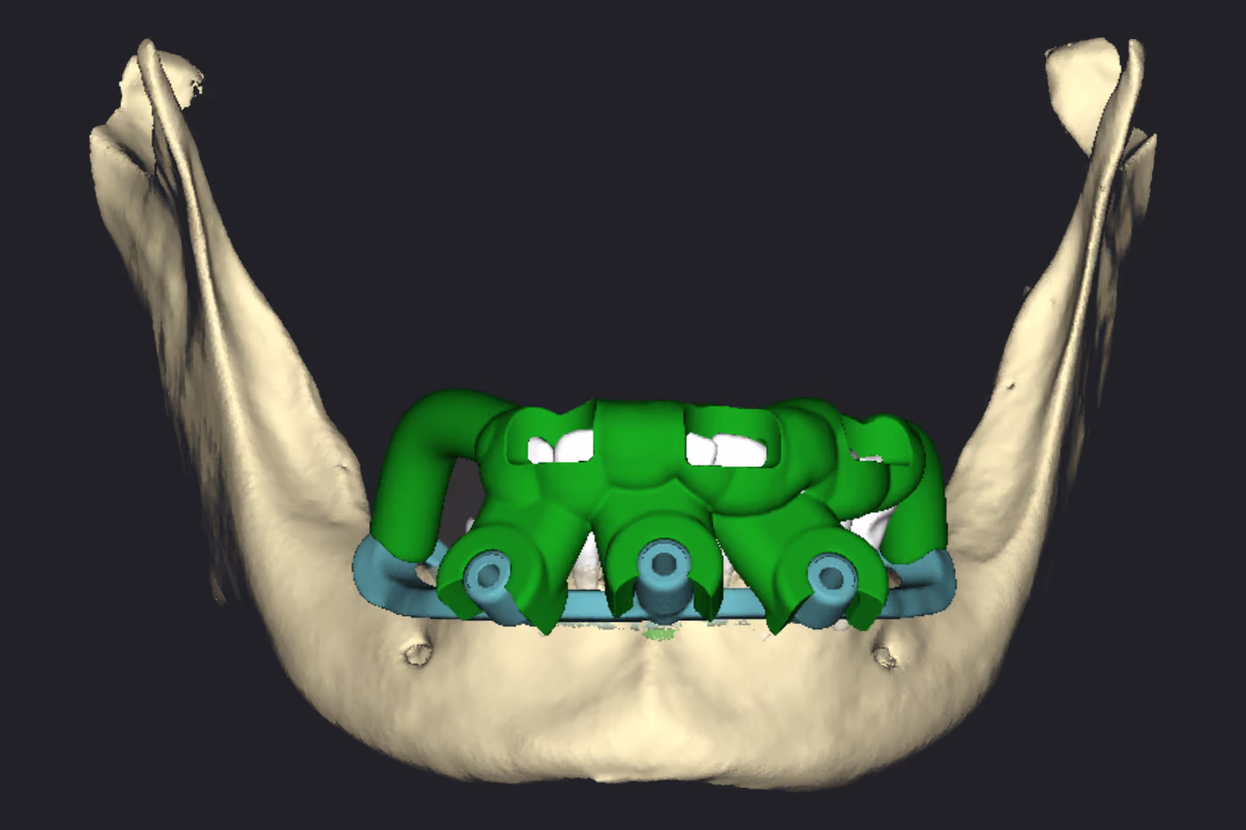 Duas guias sobrepostas sobre a mandíbula: em verde a guia dentossuportada, encaixada nos dentes remanescentes, e sob ela a barra azul da guia base com os pinos de fixação.