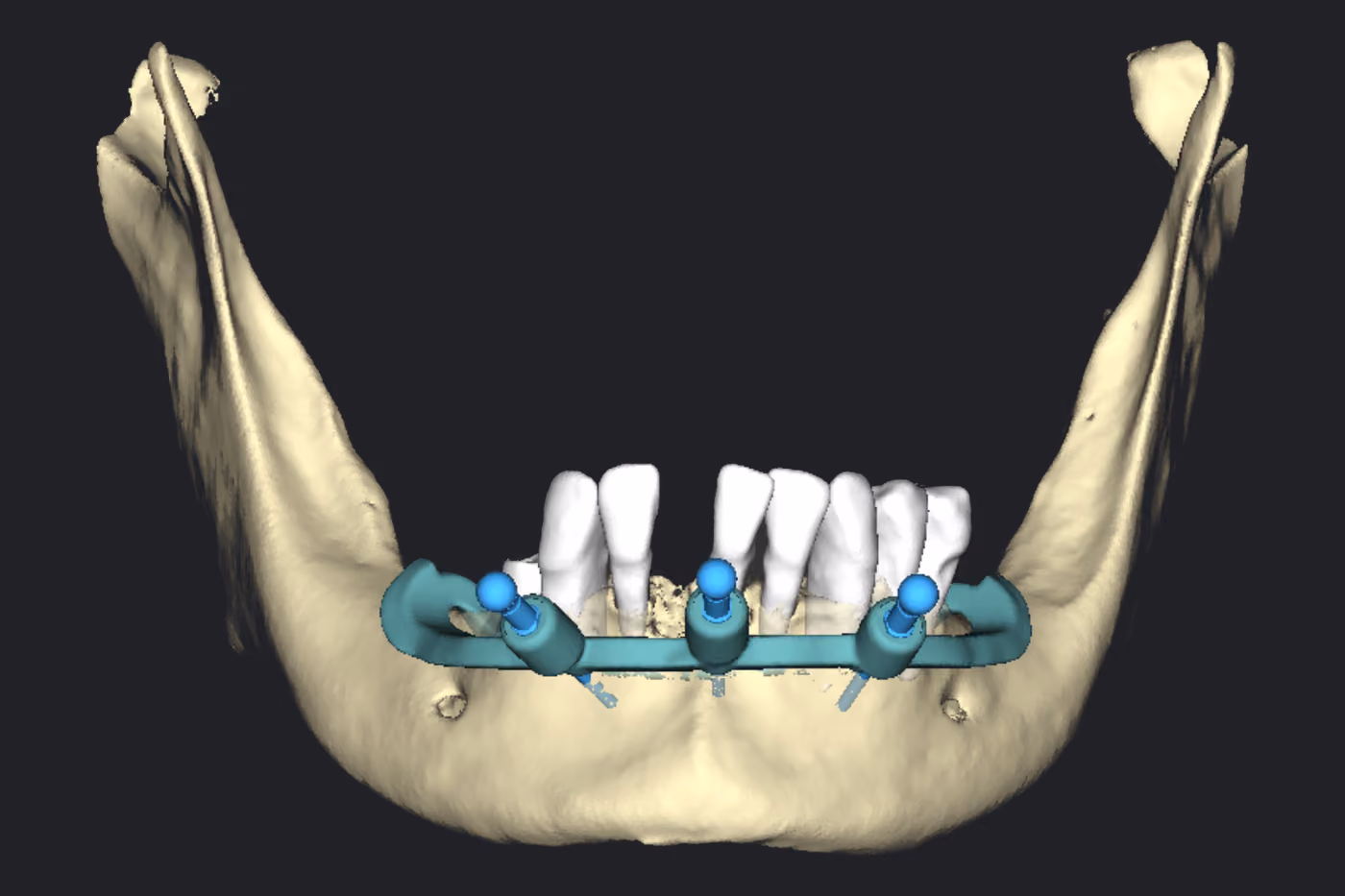 A guia base fixada ao osso da mandíbula por três pinos, com os dentes remanescentes ainda presentes.