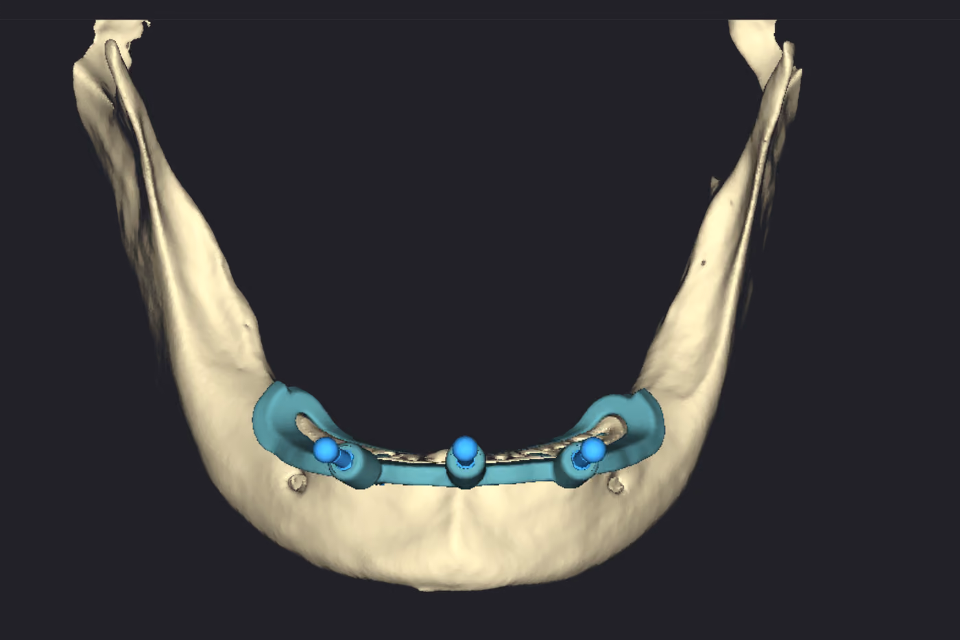 Rebordo mandibular já aplainado, com a guia base fixada acompanhando o novo contorno ósseo.