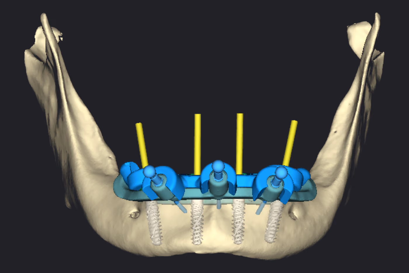 Quatro implantes instalados na mandíbula, com os cilindros amarelos indicando o eixo de acesso do parafuso protético saindo acima da guia.