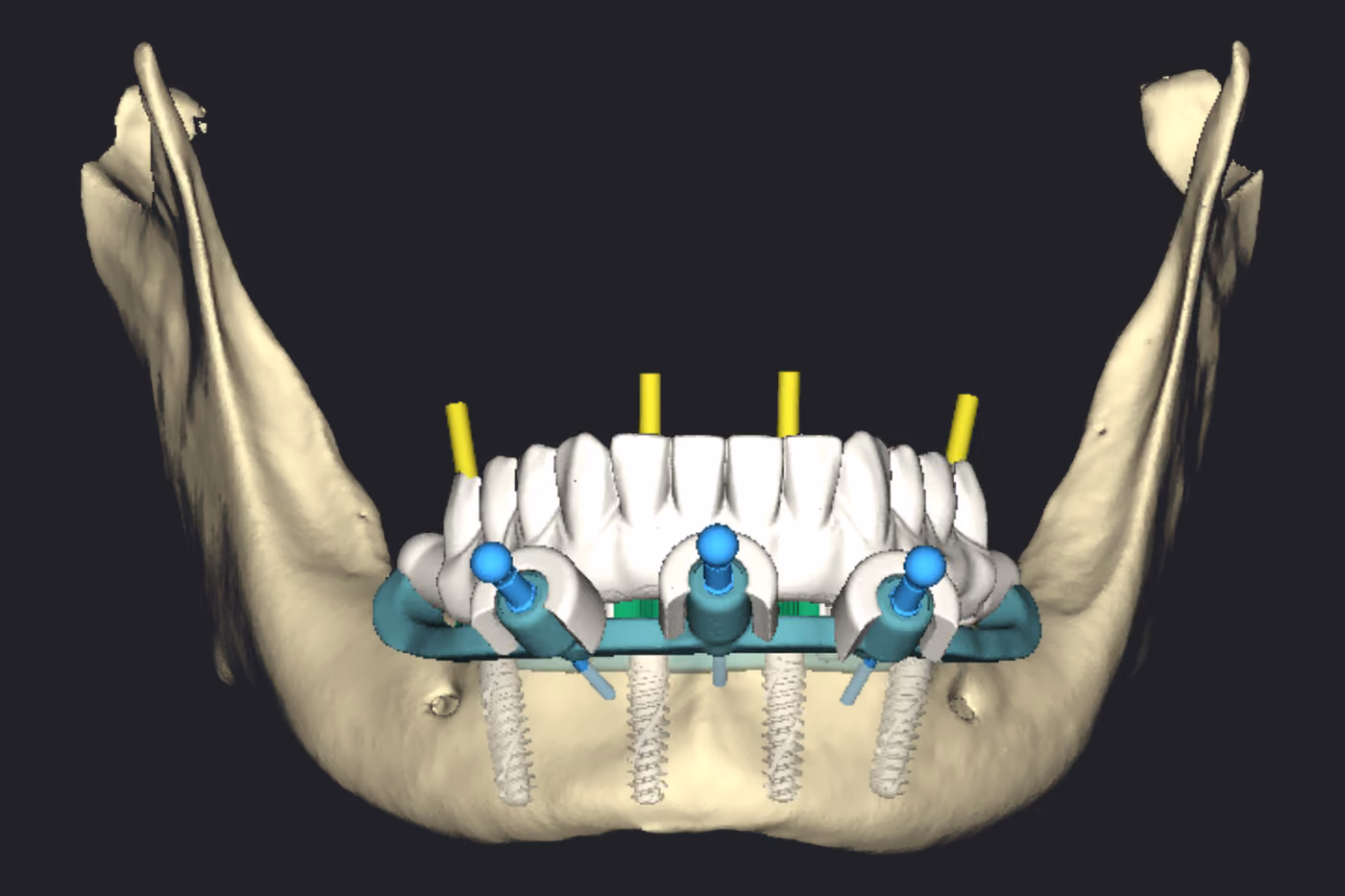 A prótese provisória posicionada sobre a mandíbula, com os mini pilares instalados e os eixos amarelos atravessando os dentes protéticos.