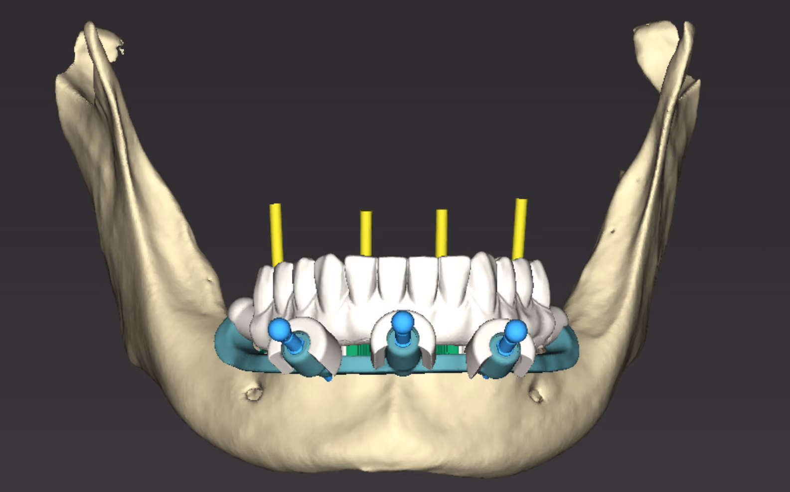 Planejamento de guia empilhável em mandíbula: a base fixada ao osso em verde-azulado, os pinos de fixação em azul, a montagem de dentes em branco e os eixos dos quatro implantes em amarelo.