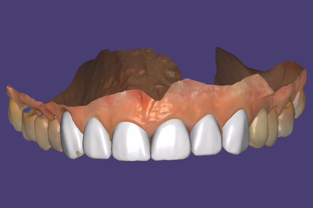 Arcada superior escaneada no exocad, com seis elementos anteriores desenhados e exibidos em branco, a cor de trabalho do software, entre os dentes posteriores naturais.