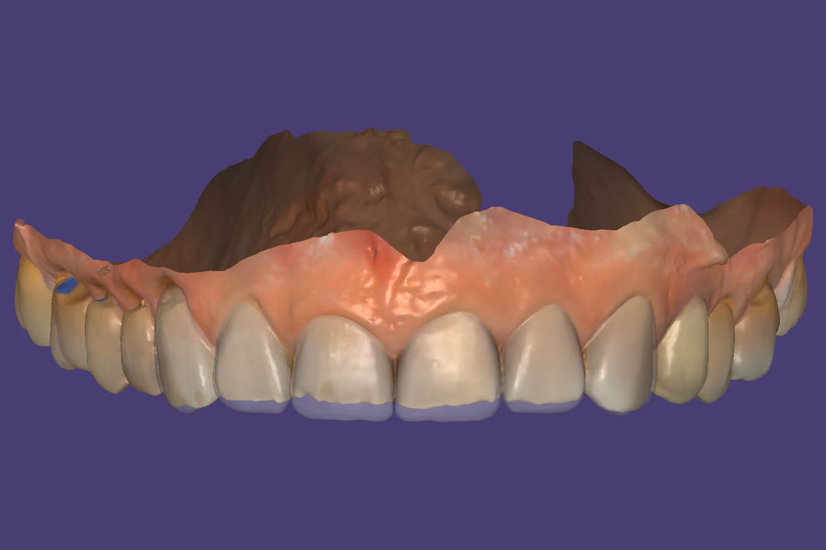 A mesma arcada com os seis elementos anteriores em visualização translúcida, com aparência mais próxima da de um dente real.
