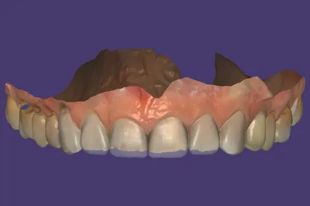 Render de coroas desenhadas no Exocad sobre o modelo digital.