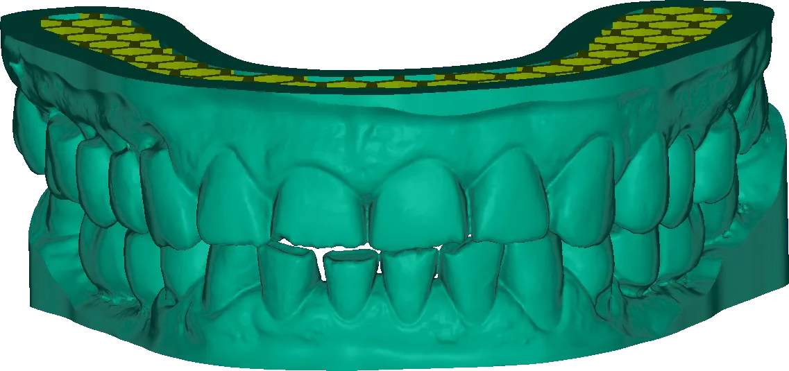 Modelos superior e inferior articulados em oclusão, em verde. O modelo superior está seccionado no topo e mostra a base oca por dentro, com uma estrutura interna em treliça amarela preenchendo os dois lados do arco.