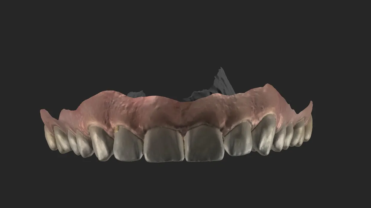 Escaneamento intraoral da arcada superior sobre fundo escuro, com o tecido mole em rosa e os dentes em tons de cinza-claro.