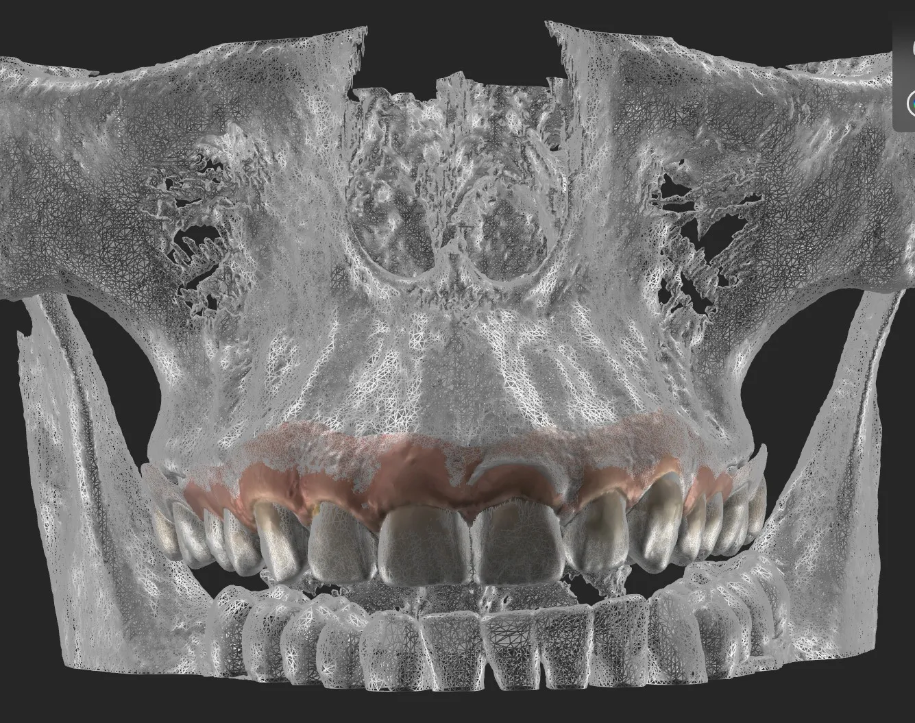 O mesmo escaneamento sobreposto à tomografia: maxila e mandíbula aparecem em malha branca e o tecido mole rosa fica translúcido por cima do osso.