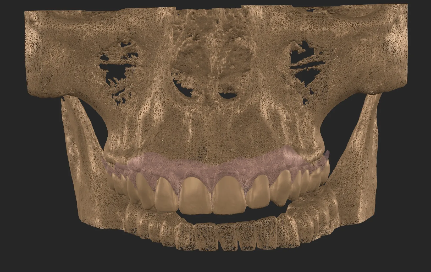A mesma sobreposição num render em tom de osso, com o tecido mole em roxo translúcido sobre a maxila e os dentes superiores em destaque.