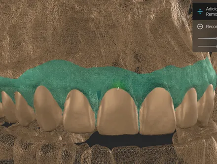 Tecido mole destacado em verde-água sobre os dentes anteriores, durante a manipulação no software.