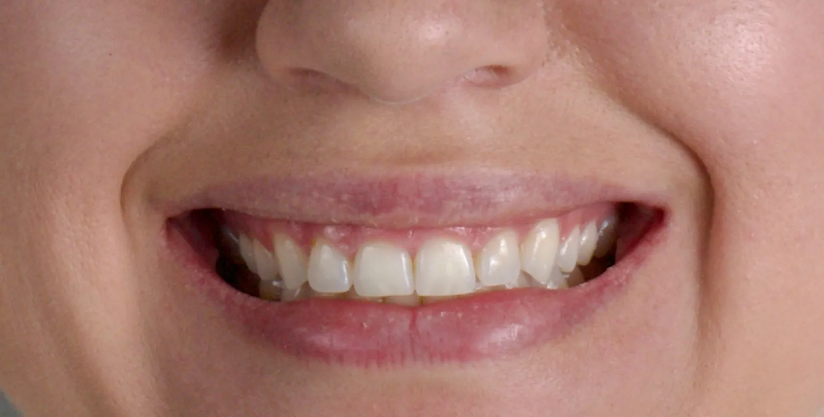 Sorriso do paciente na situação atual, com os incisivos superiores curtos e o contorno gengival mais baixo.