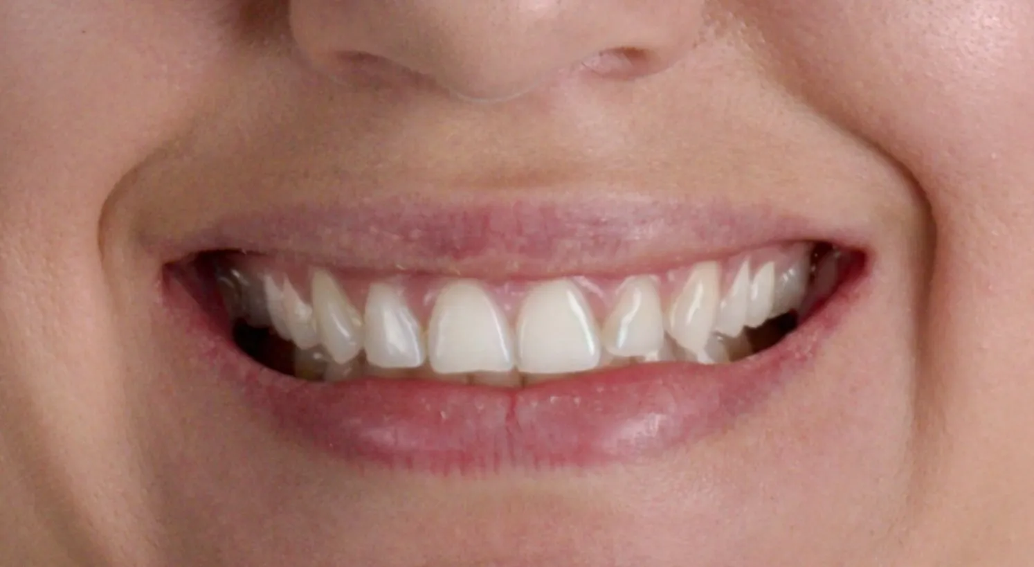 O mesmo sorriso na simulação do Smilecloud, com o contorno gengival reposicionado e os incisivos superiores aparecendo mais longos.