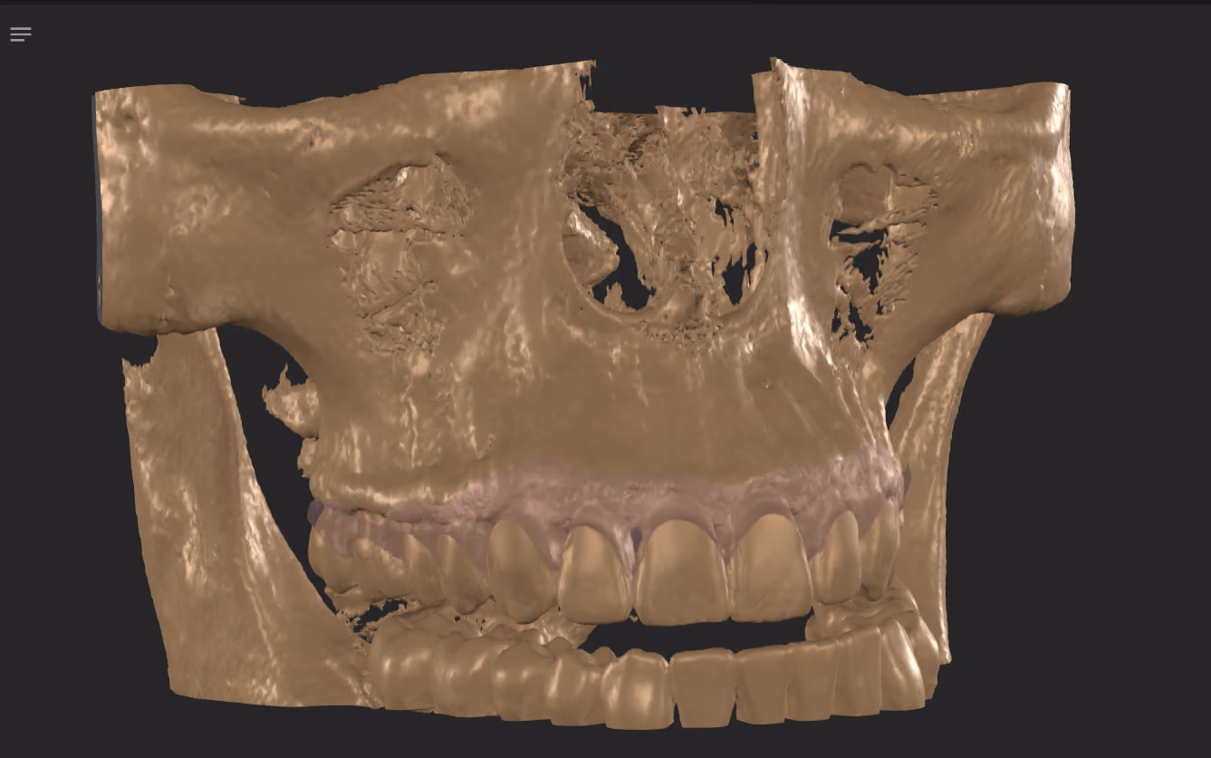 Reconstrução tomográfica em vista lateral no SmileCloud, com maxila, mandíbula e arcadas dentárias